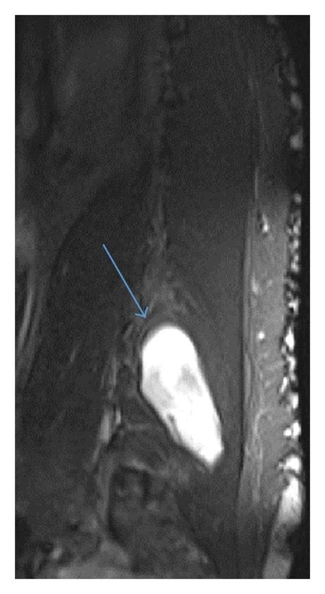 A Sagittal T2 Shows Right Erector Spinae Multifidus Muscle