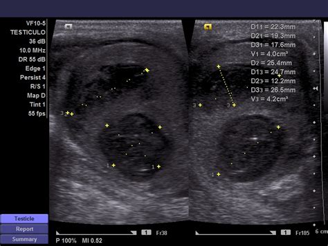 Testicular Abscess And Pyocele Image