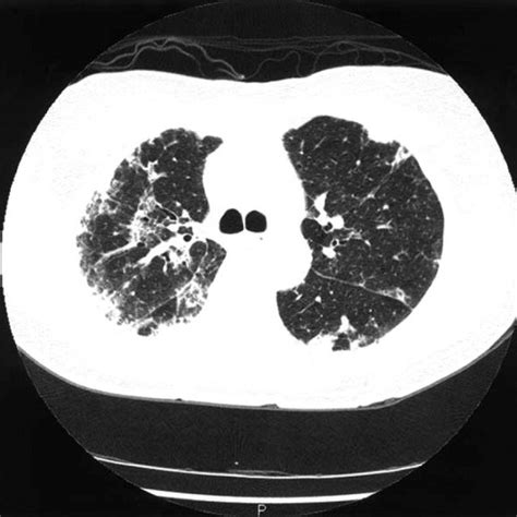 Ct Scan Showing Interstitial Thickening And Ground Glass Opacity Within Download Scientific