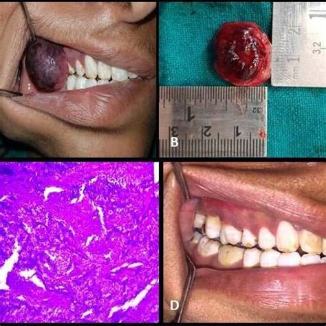 Pdf Pyogenic Granuloma A Case Report