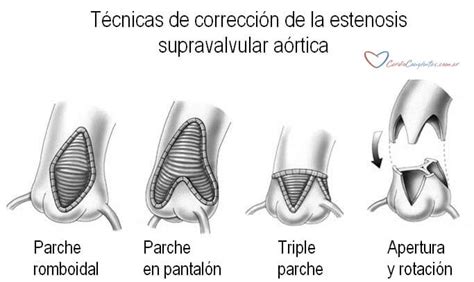 Estenosis Supravalvular Aórtica