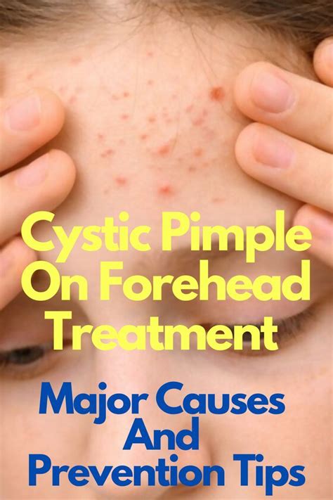 How To Treat Cystic Pimple On Forehead Causes And Prevention Artofit