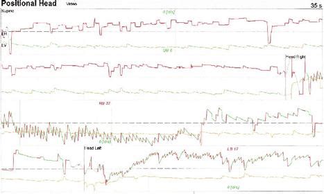 Horizontal Canal BPPV | BalanceMD