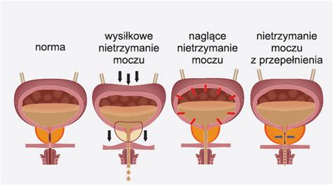 Nietrzymanie moczu u mężczyzn Leczenie 4 SPOSOBY