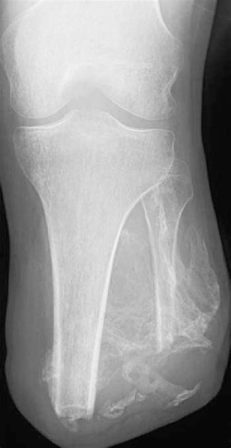 Below Knee Amputation Radiograph Of Mature Ectopic Bone In A