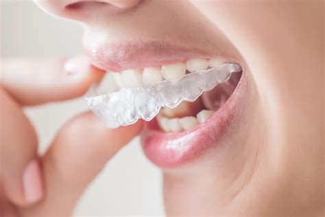 Tips And Tricks Every Invisalign Patient Should Know Josey Lane