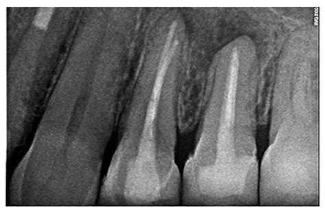 Revista Canal Abierto Management Of A Cyst Of Apical Origin With Non