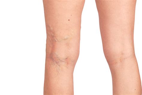 Spider Veins Causes Symptoms And Treatment Advanced Physical Medicine