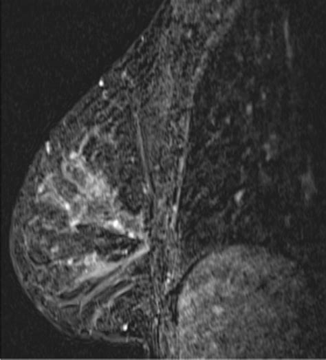 Hormonal Effects On Breast Density Fibroglandular Tissue And