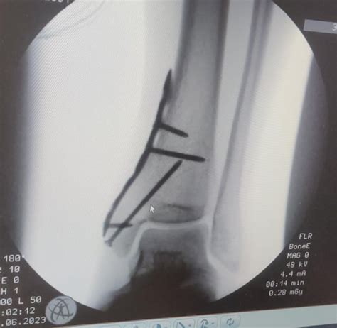 Medial malleolus fracture post surgery. Any advice for best possible ...