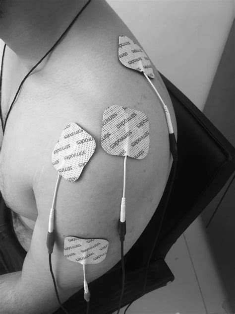 Application Of The NMES And Electrode Pad Placement Locations