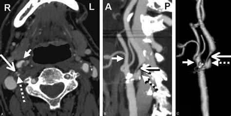 Quantification Of Carotid Stenosis On Ct Angiography American Journal Of Neuroradiology