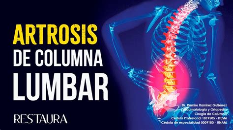 Artrosis De Columna Lumbar Youtube