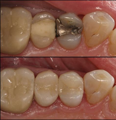 Safe Removal of Mercury in Amalgam Fillings with IV Sedation