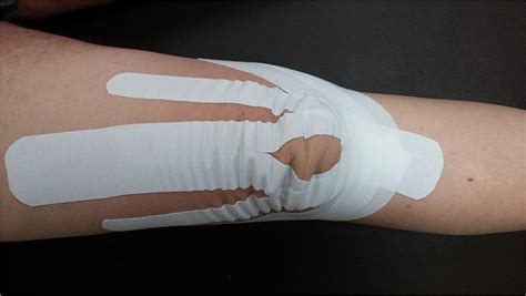 The Kinesio Taping Application The Completed Kt Application View Two