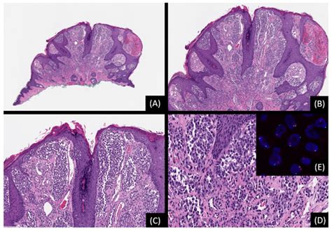 Spitz Melanocytic Tumors A Fascinating 75 Year Journey Pmc