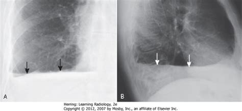 Clin Med Exam Pleural Dz Flashcards Quizlet