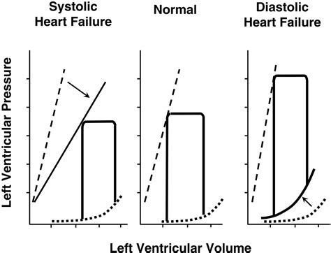 Contractile Behavior Of The Left Ventricle In Diastolic Heart Failure