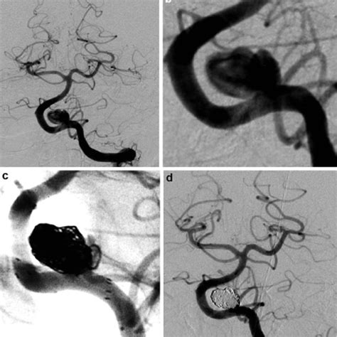 MRI examination of a patient with a mid-size VA aneurysm. The ...