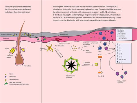 An Update On The Microbiology Immunology And Genetics Of Seborrheic