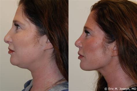 Deviated Septum Surgery Before And After