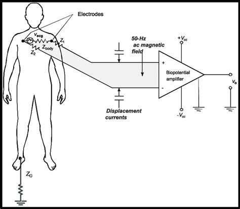 Capacitive Coupling To Patient Electrodes And Electrode Leads