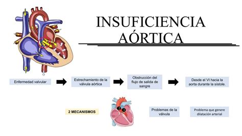 INSUFICIENCIA AÓRTICA CUIDADO MEDICO uDocz