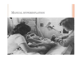 Use Of Manual Hyperinflation In ICU PPT