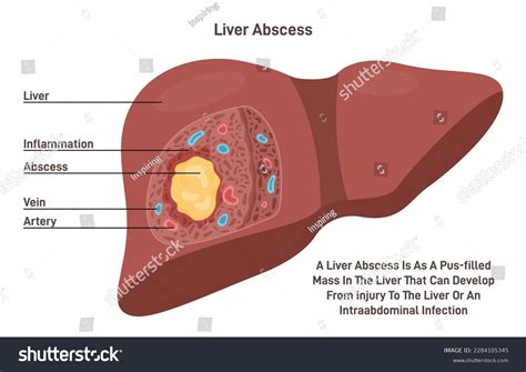 Liver Abscess Human Internal Organ Tissue Stock Vector Royalty Free