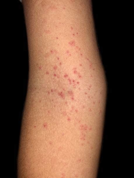 Bumpy Rash On Forearms