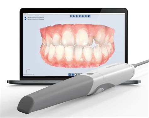 3D Dental Imaging: Intraoral Scanning | Mint Mini Dental Implants