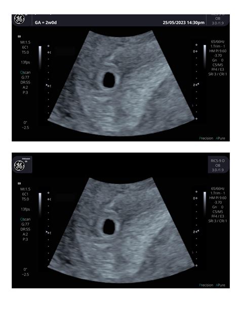 6 Week Transvaginal Ultrasound