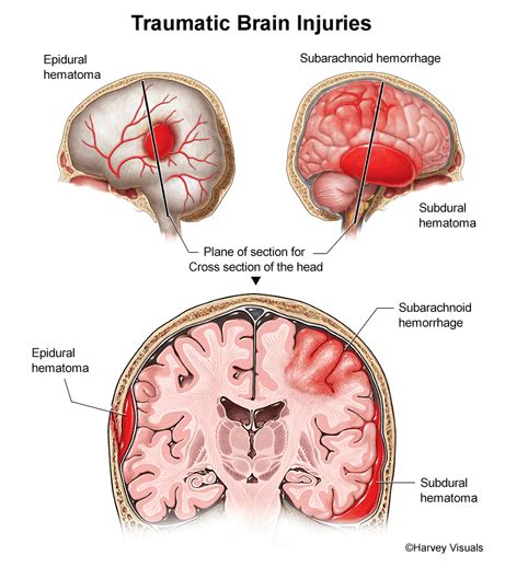 Traumatic Brain Injury: Causes Vary - Personal Injury, Brain Injury ...