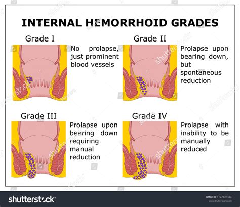 Internal Hemorrhoid Grades Color Vector Scheme 库存矢量图（免版税）1122120344