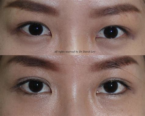 The Art And Science Of Beauty Double Eyelid Surgery