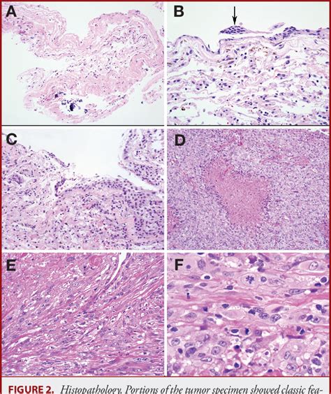 Figure From Anaplastic Meningioma Arising From A Radiologically