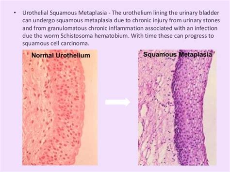 Metaplasia & Dysplasia