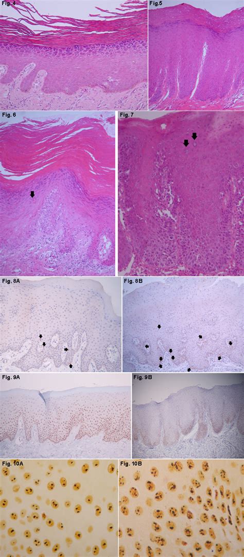 Leukoplakia Tongue Histology