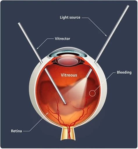 Vitrectomy: Meaning, Reasons & Risks | by Bhartieyefoundation | Medium