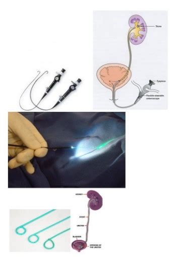 Cirurgia Do C Lculo Renal Laser Dr Leandro Kruel