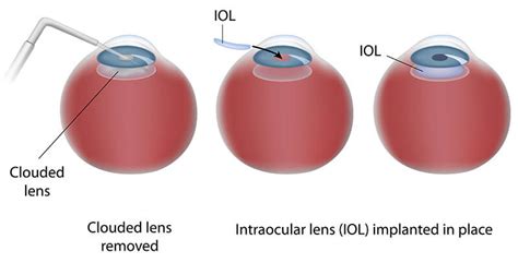 Cataract Surgery Orlando Premium Lenses Ocoee Florida Eye