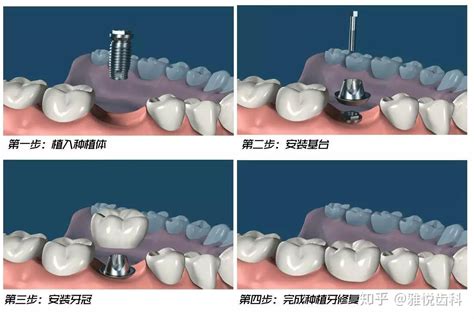 种植牙步骤 知乎