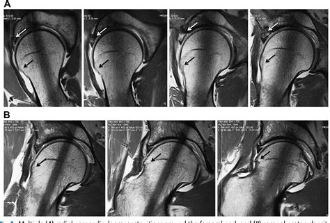 Figure 1 from MRI of hip osteoarthritis and implications for surgery ...