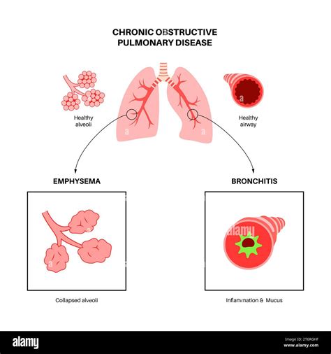 Chronic Obstructive Pulmonary Disease Copd Illustration Stock Photo