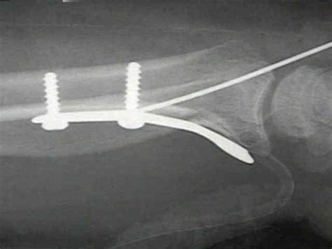 Volar Barton S Fractures Wheeless Textbook Of Orthopaedics