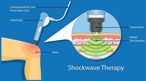 Enraf Nonius Shockwave Therapy Romyna Menendez Physiotherapist