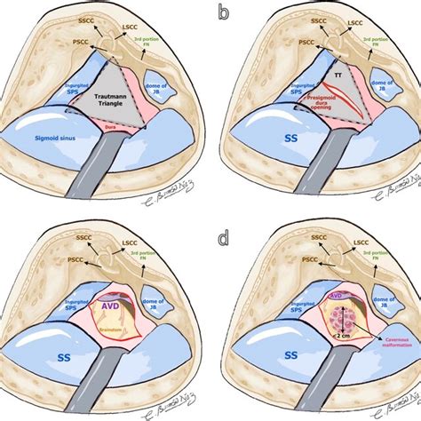 Preoperative Neuroimaging Assessment Of The Cavernous Malformation And Download Scientific