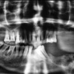 Orthopantomograph Showing A Well Defined Unilocular Radiolucent Lesion