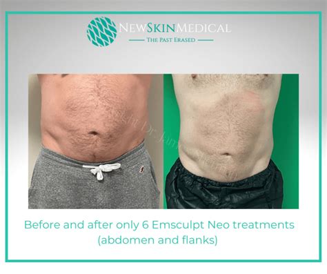 Before & After Emsculpt Neo | Target Fat & Stimulate Muscle