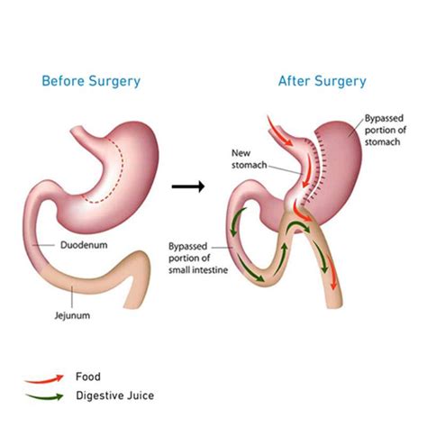 Mini Gastric Bypass Brisbane Obesity Clinic